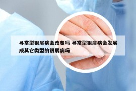 寻常型银屑病会改变吗 寻常型银屑病会发展成其它类型的银屑病吗