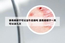 狼毒癣痒宁可以治牛皮癣吗 狼毒癣痒宁一天可以涂几次