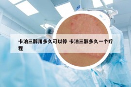 卡泊三醇用多久可以停 卡泊三醇多久一个疗程