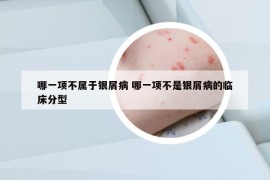 哪一项不属于银屑病 哪一项不是银屑病的临床分型