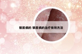 银屑病的 银屑病的治疗有效方法