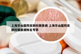 上海华山医院皮肤科银屑病 上海华山医院皮肤科银屑病知名专家