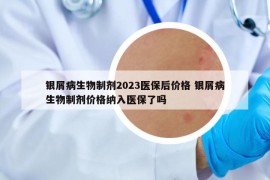 银屑病生物制剂2023医保后价格 银屑病生物制剂价格纳入医保了吗