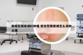 脓疱型银屑病红肿痛 脓包型银屑病怎么消肿止痛