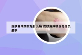 皮肤变成橘皮是什么癣 皮肤变成橘皮是什么癣啊