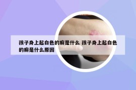 孩子身上起白色的癣是什么 孩子身上起白色的癣是什么原因