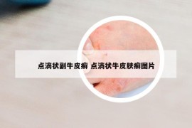 点滴状副牛皮癣 点滴状牛皮肤癣图片