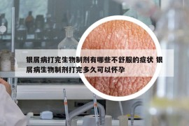 银屑病打完生物制剂有哪些不舒服的症状 银屑病生物制剂打完多久可以怀孕