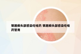 银翘癣头部感染吃啥药 银翘癣头部感染吃啥药管用