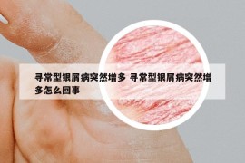 寻常型银屑病突然增多 寻常型银屑病突然增多怎么回事