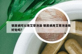 银屑病可以用艾草泡澡 银屑病用艾草泡澡有好处吗?