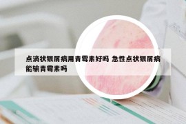 点滴状银屑病用青霉素好吗 急性点状银屑病能输青霉素吗