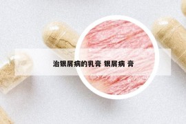 治银屑病的乳膏 银屑病 膏