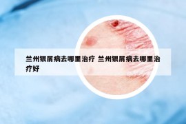 兰州银屑病去哪里治疗 兰州银屑病去哪里治疗好