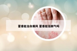 藿香能治白癜风 藿香能治脚气吗