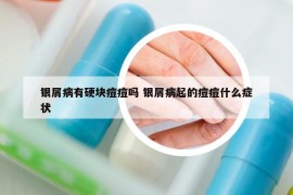 银屑病有硬块痘痘吗 银屑病起的痘痘什么症状