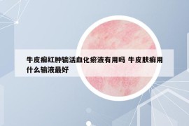 牛皮癣红肿输活血化瘀液有用吗 牛皮肤癣用什么输液最好