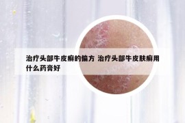 治疗头部牛皮癣的偏方 治疗头部牛皮肤癣用什么药膏好