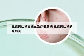 北京同仁堂克银丸治疗银屑病 北京同仁堂的克银丸