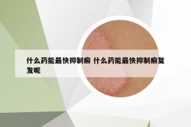 什么药能最快抑制癣 什么药能最快抑制癣复发呢