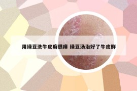 用绿豆洗牛皮癣很痒 绿豆汤治好了牛皮鲜