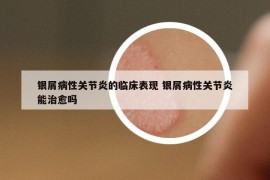 银屑病性关节炎的临床表现 银屑病性关节炎能治愈吗