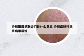 协和银屑病联合门诊什么意思 协和皮肤科银屑病谁最好