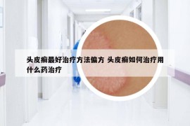 头皮癣最好治疗方法偏方 头皮癣如何治疗用什么药治疗