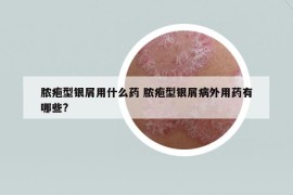 脓疱型银屑用什么药 脓疱型银屑病外用药有哪些?