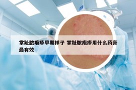 掌趾脓疱疹早期样子 掌趾脓疱疹用什么药膏最有效