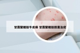 甘露聚糖肽牛皮癣 甘露聚糖肽胶囊治疣