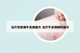 冶疗皮肤病牛皮癣偏方 治疗牛皮病癣的偏方