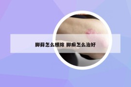 脚藓怎么根除 脚癣怎么治好