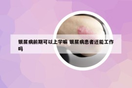 银屑病前期可以上学嘛 银屑病患者还能工作吗