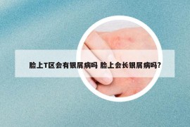 脸上T区会有银屑病吗 脸上会长银屑病吗?