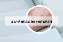 急性牛皮癣的症状 急性牛皮鲜能彻底吗