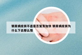 银屑病皮损不退是否复发加快 银屑病皮损为什么下去那么慢