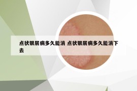 点状银屑病多久能消 点状银屑病多久能消下去