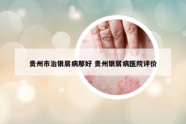 贵州市治银屑病那好 贵州银屑病医院评价