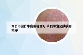 海口市治疗牛皮癣哪里好 海口专治皮肤病哪家好