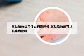 掌趾脓包症用什么药膏好使 掌趾脓包病可以临床治愈吗