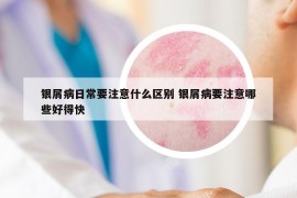 银屑病日常要注意什么区别 银屑病要注意哪些好得快