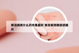 银消病用什么药效果最好 银皮癣初期症状图片