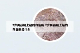 2岁男孩腿上起的白色癣 2岁男孩腿上起的白色癣是什么