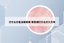 打什么针能治银屑病 银屑病打什么针几万块