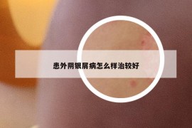 患外阴银屑病怎么样治较好