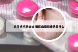 银屑病初期症状 银屑病初期症状是什么