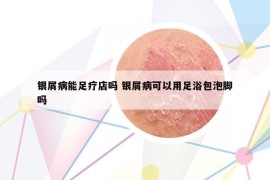 银屑病能足疗店吗 银屑病可以用足浴包泡脚吗