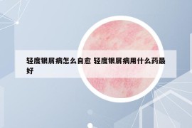 轻度银屑病怎么自愈 轻度银屑病用什么药最好