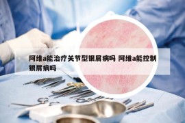 阿维a能治疗关节型银屑病吗 阿维a能控制银屑病吗